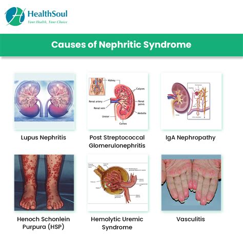 Nephritic Syndrome Symptoms And Treatment Healthsoul
