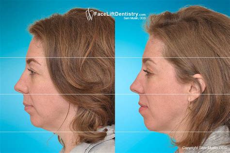Eliminating Jaw Tension With Jawtrac Jaw Position Technology