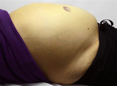 Also called gastric cancer, the disease usually grows slowly over many years. Malignant Ascites: Diagnosis and Management - Cancer ...