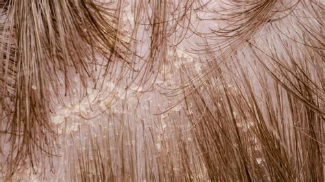 Scalp Psoriasis Vs Dandruff Symptoms Pictures And Causes Vlrengbr