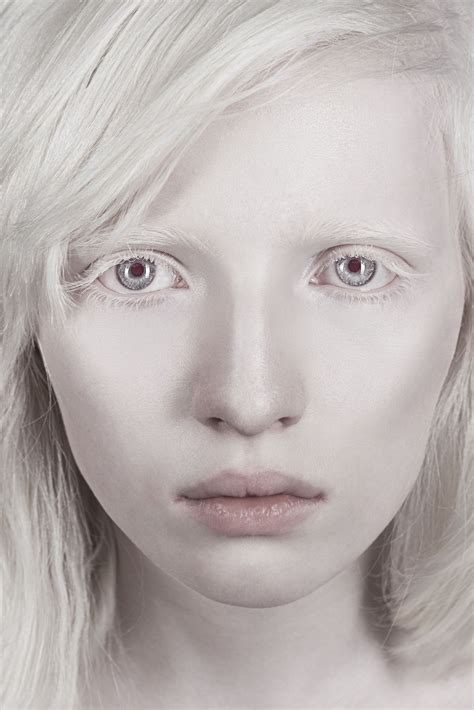 My Lovely Girl By Kumarov Amkote Michael Albino Model Albinism