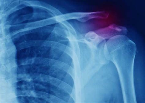 Ac Joint Separation Orthopedic Shoulder Specialist Vail Aspen