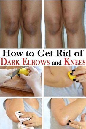 You can sprinkle some sugar on the lemon wedge to increase its effectiveness. How To Get Rid Of Dark Elbows And Knees Naturally | Dark ...