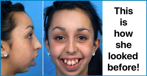 Look At This Amazing Transformation Of A Girl Who Had Dental Deformity