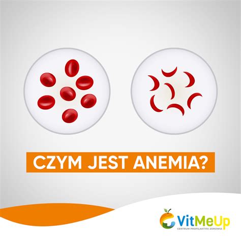 Anemia Przyczyny Objawy Diagnostyka Leczenie