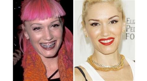 Rhinoplasty in her early years. Gwen Stefani Before And After Plastic Surgery gwen stefani ...