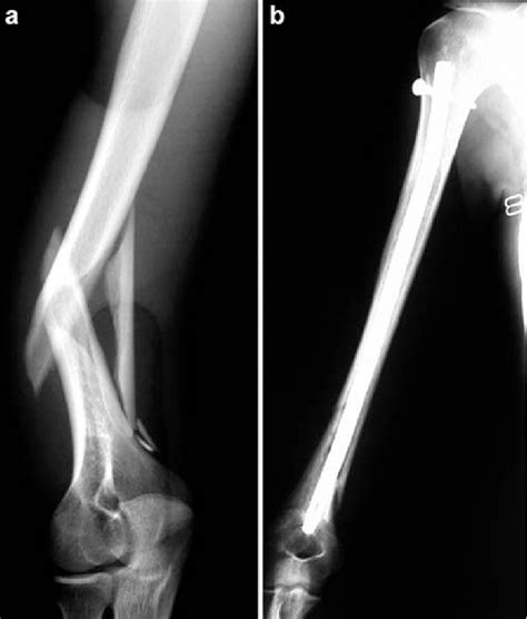A Distal Third Humeral Shaft Fracture With Associated Radial Nerve