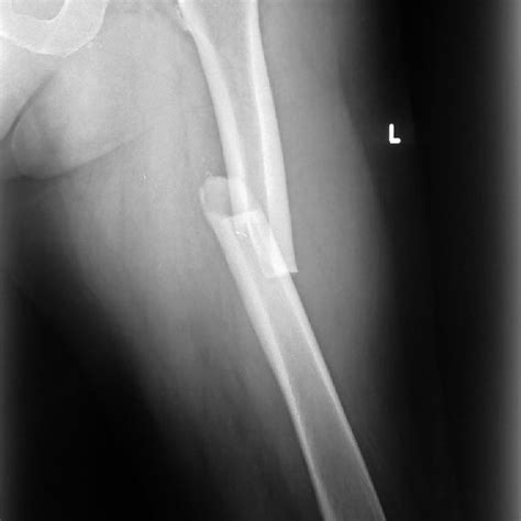 Both Femurs At The Time Of The Right Femoral Shaft Fracture Figure 1