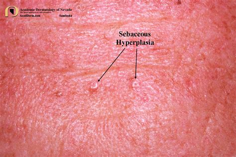 sebaceous gland hyperplasia lips