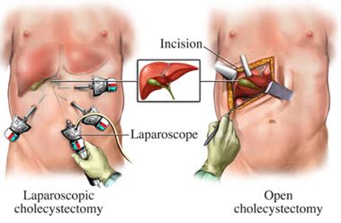 Laparoscopic Gallbladder Surgery Surgical Specialists Of Southwest