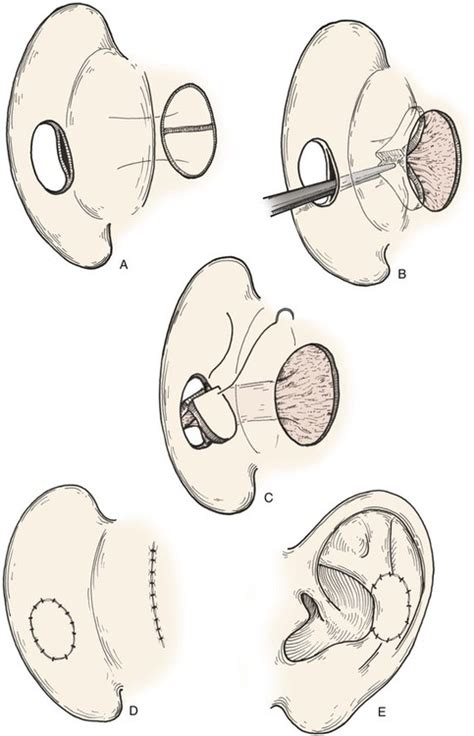 22 Reconstruction Of The Auricle Pocket Dentistry