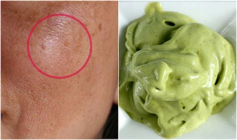 10 Ways To Reduce Discolored Patches On Face