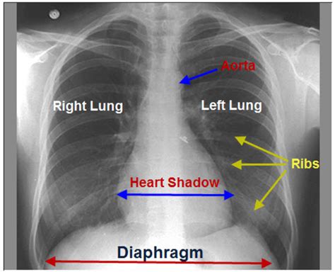 Abnormal parenchymal sonographic findings can only be detected if the vppi is involved (if the abnormality was proximal with no peripheral involvement. Reading The Chest X-Ray (Chest Radiography): Identifying A Normal Chest X-Ray | HubPages