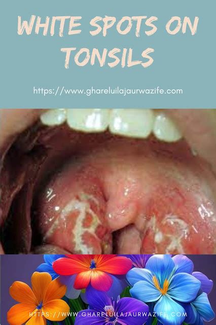 White Spots On Tonsils