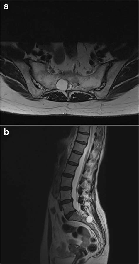 Axial A And Sagittal B T2 Weighted Magnetic Resonance Images