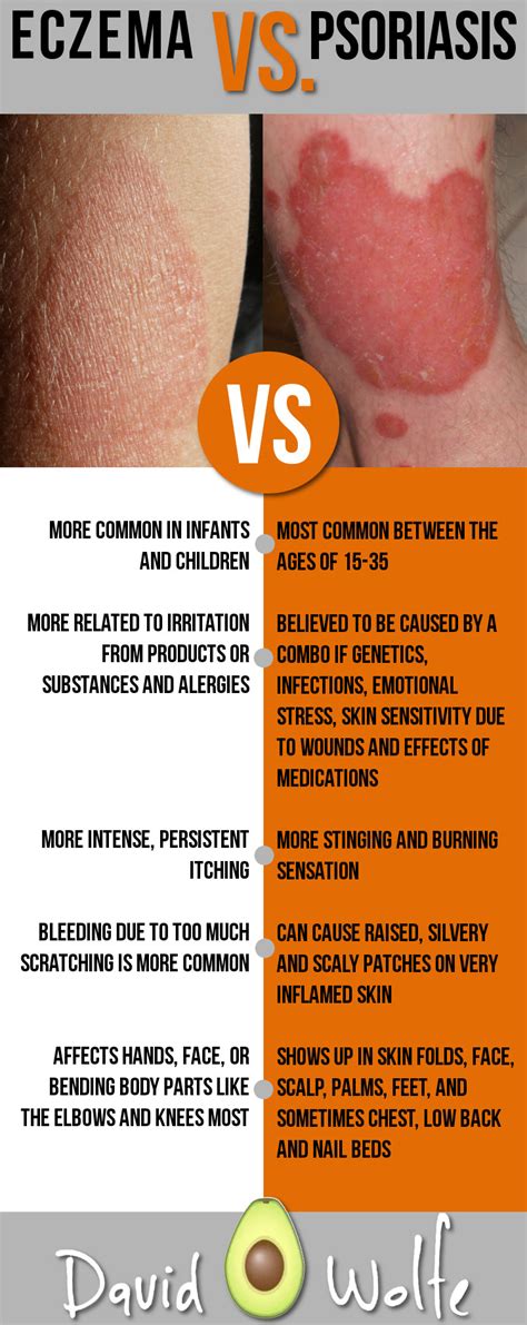 Eczema Symptoms 9 Signs To Watch Out For David Avocado Wolfe