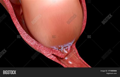 Women who have given birth have a cervix that will dilate more quickly in the future when it is the next baby's turn to come into the picture. First Stage: Dilation Image & Photo (Free Trial) | Bigstock