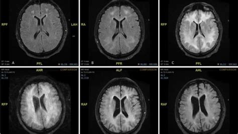 Bmj Cambios En Resonancia Magnética Del Cerebro De Un Paciente Con