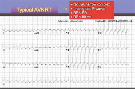 Svt Ecg