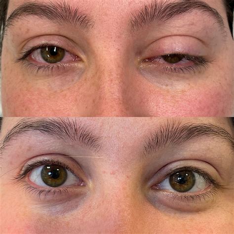 Understanding Eyelid Drooping Causes Symptoms And Treatment Options