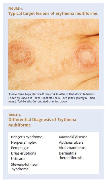 Erythema Multiforme Target Lesions