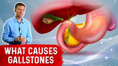 What Really Causes Gallstones Drberg Youtube