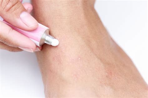Premium Photo Rash From Sweat On Foot With Cream For Cure