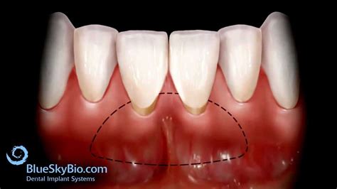 Patient Treatment Videos Free Gingival Graft Youtube