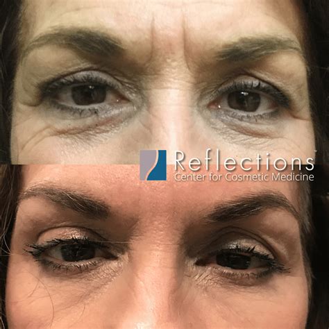 Botox For Under Eye Wrinkles And Frown Lines Before And After Photos New