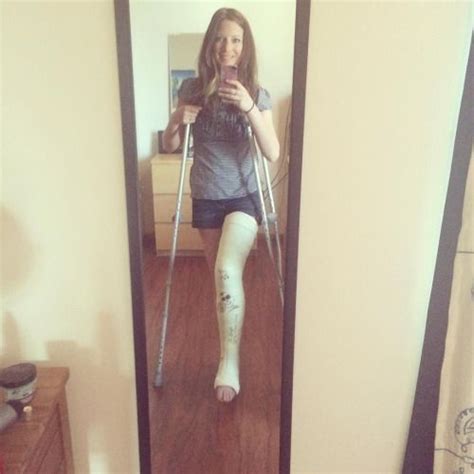 Llc Long Leg Cast On Crutches Gipsbein Gips Beine