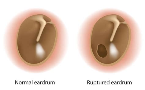 Tympanic Membrane Perforation So You Have A Ruptured Ear Drum Now