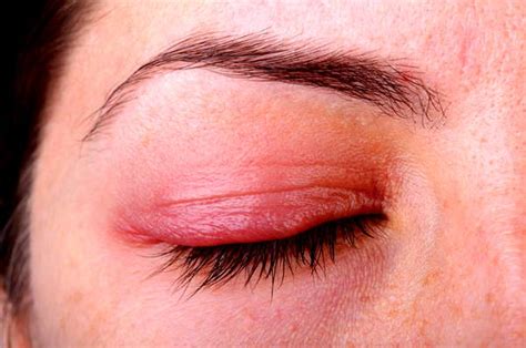We did not find results for: Healthool Pimple on Eyelid (How to get rid of) - (2020 ...