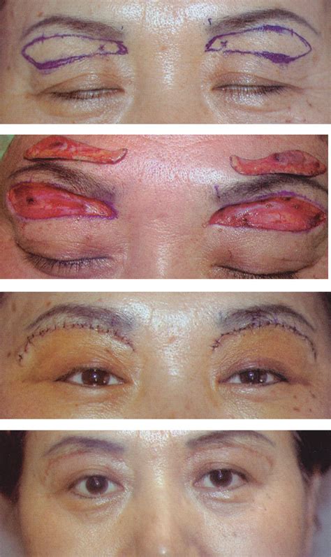 Eyelid Surgery By Prof Dr Cn Chua 蔡鐘能 April 2011
