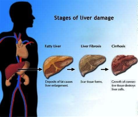 Stages Of Liver Damage