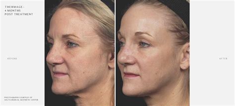 Thermage Flx Before And After