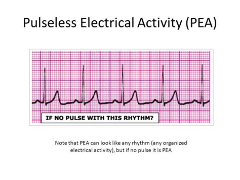 Pulseless Electrical Activity Pea Diagram Quizlet