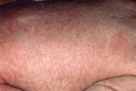 Toxic Shock Syndrome Skin Rash