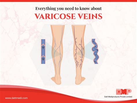 The Ultimate Guide To Understanding Varicose Veins Blog By Dmp