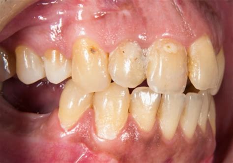 Caries And White Spot Lesions Colgate® Professional