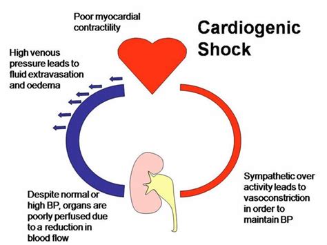 Cardiogenic Shock Nursing Crib