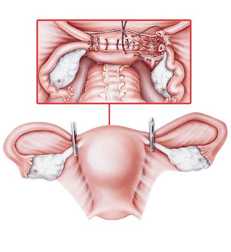 female anatomy after hysterectomy anatomy book
