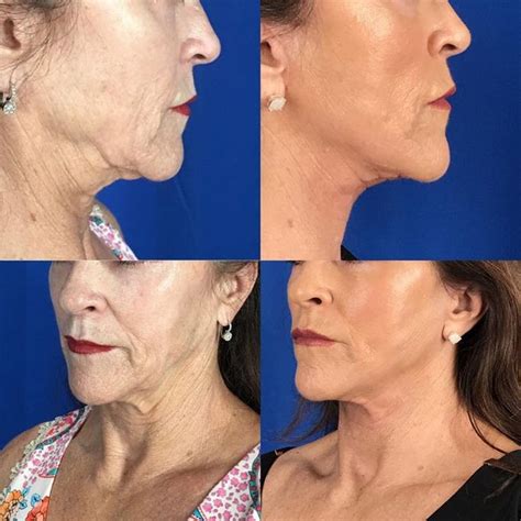 We Cant Get Over How Fabulous Our Patient Looks After Her Mini Facelift Procedure Spring