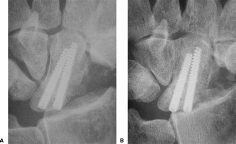 Clinical Outcomes Of Scaphoid And Triquetral Excision With Capitolunate Arthrodesis Versus
