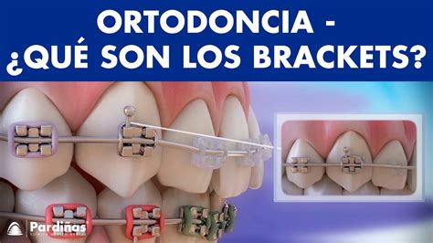 Ortodoncia Brackets Y Otras Partes Del Aparato Dental © Youtube