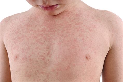 12 Common Skin Rashes In Children And Their Treatments