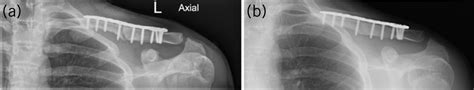 Symptomatic Malunion After Midshaft Clavicle Fracture In An Adolescent