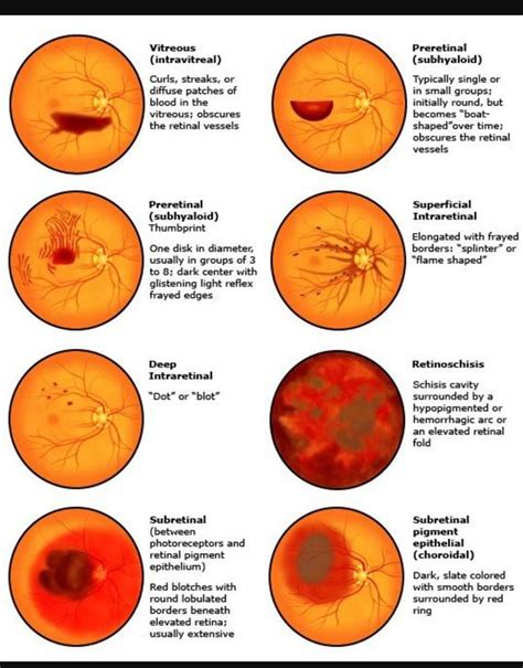 Fundoscopy Anatomia Umana Oculista Optometria