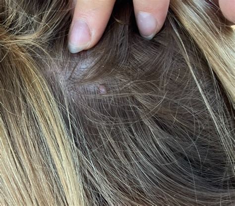 What Could That Bump On My Scalp Be Rdermatologyquestions