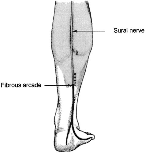 Sural Nerve Sensory Distribution