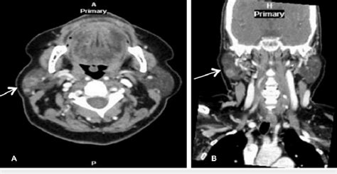Ct Neck Imaging Of The Parotid Gland Lesion Axial A And Coronal B
